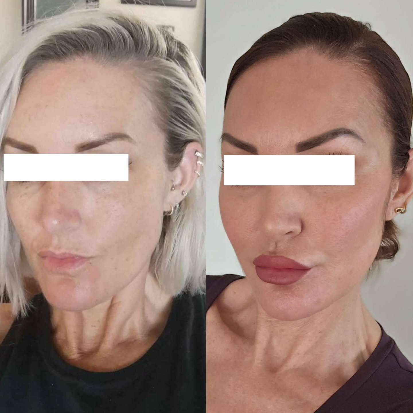 ✨ My Personal Glow Up ✨

Looking back at an old photo of myself from about 5 years ago and I&rsquo;m genuinely shook at how far my skin &amp; face (and confidence) have come.

It hasn&rsquo;t been one quick fix,  it&rsquo;s been a slow, steady journe