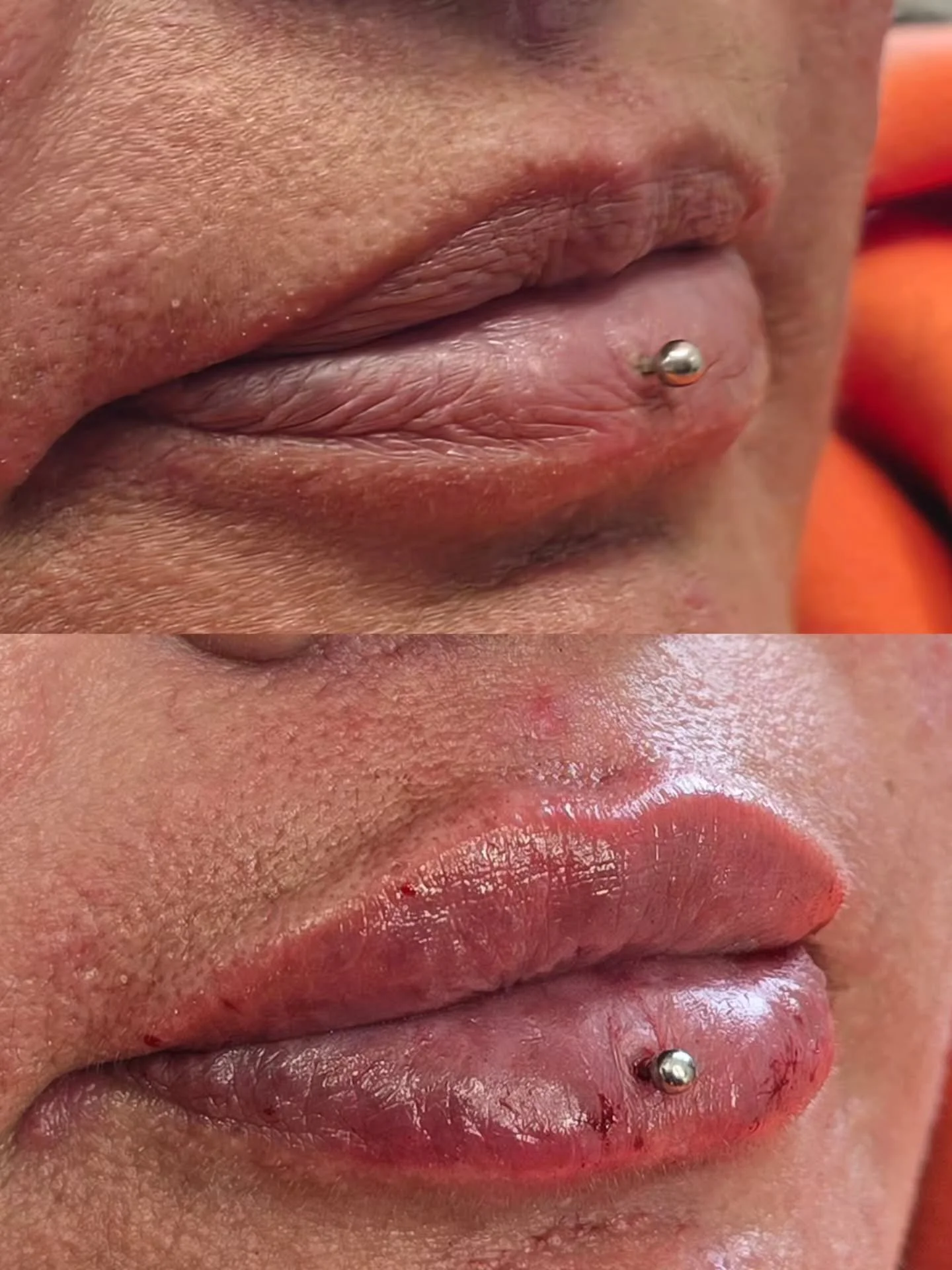 Beautiful, Lush Lips Loading...

With carefully placed dermal filler, we can:
✨ Restore hydration 
✨ Enhance natural shape and borders
✨ Subtly replace lost volume

Beautiful, Lush Lips &mdash; Restored &amp; Refined

When it comes to lip filler it&r