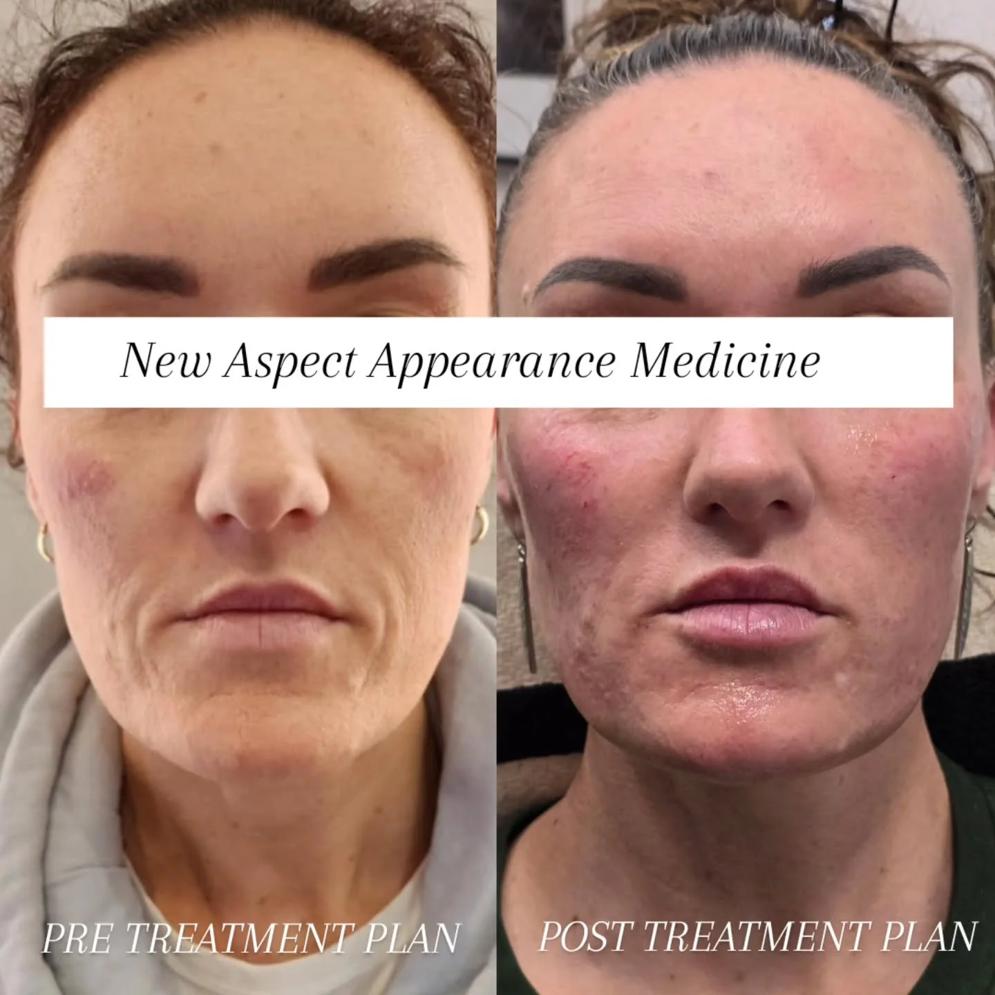 Full Face Transformation&hellip;
Slow, steady, and life changing 

This beautiful journey has taken place over 2 years,  Using different modalities to support the face as it naturally ages and help turn back the clock with a beautiful rejuvenation.

