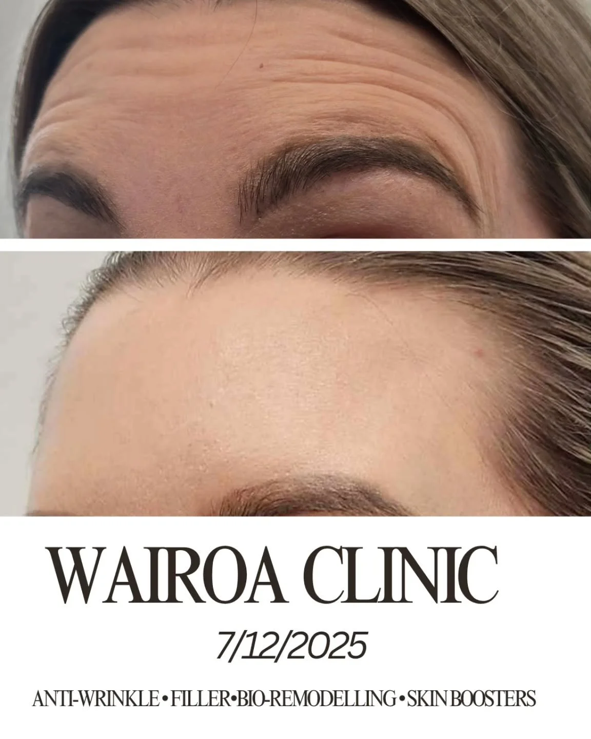 Wairoa &ndash; I&rsquo;m Coming to You! ✨

I&rsquo;m so excited to announce a pop-up clinic in Wairoa

If you&rsquo;ve been wanting a personalised treatment plan, a refresh, or just a genuine chat about your skin journey, this is the perfect chance.
