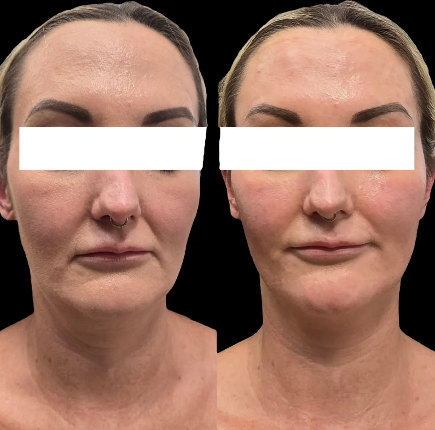 Let&rsquo;s talk about the pillars of facial support: temples, cheeks, marionettes &amp; the piriform 

These are the zones that support and lift and when they lose volume, the face starts to look tired, hollow and pulled down.

✨ Temples
As we age, 