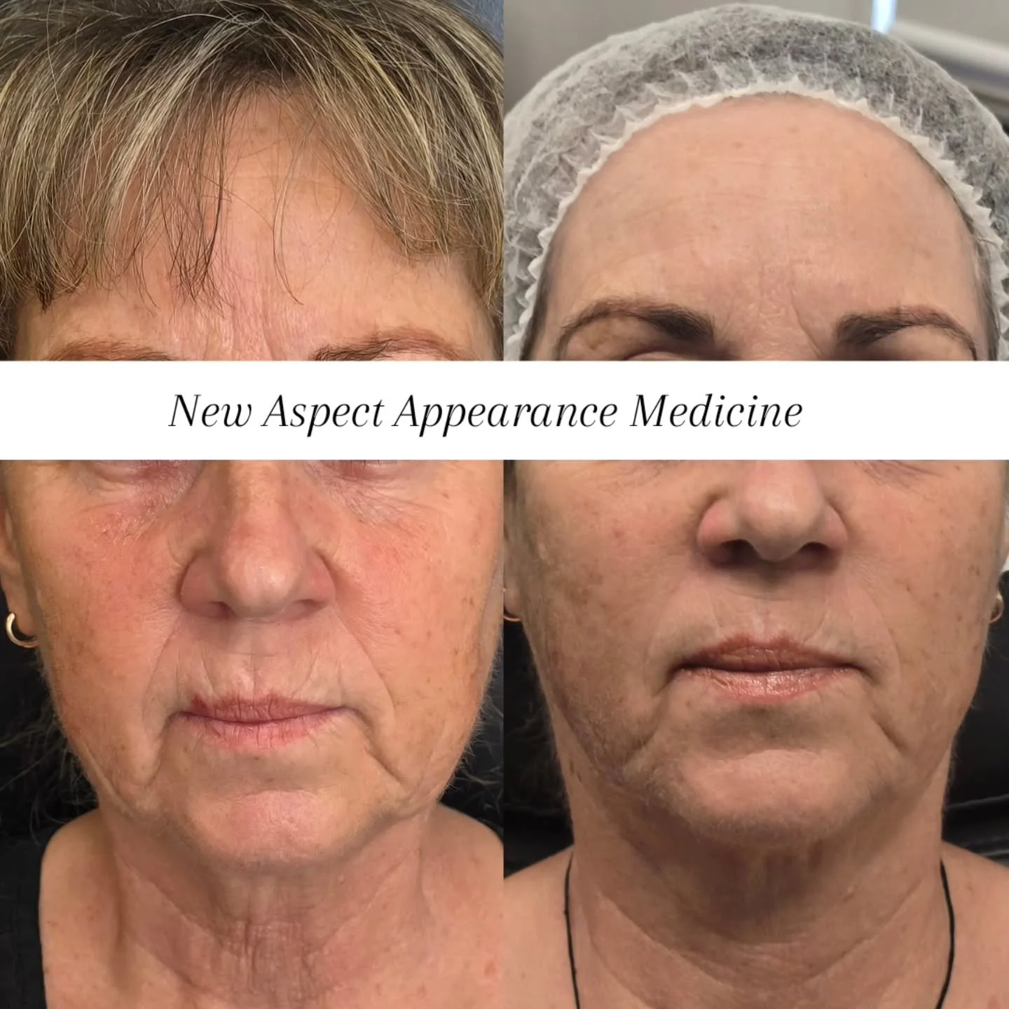 THE POWER OF RF MICRONEEDLING 

I wasn't going to share this result as I wanted to wait until we have finished the course of treatments but I think it's quite nice to show the results that can happen after just one treatment of RF Microneedling. 

He
