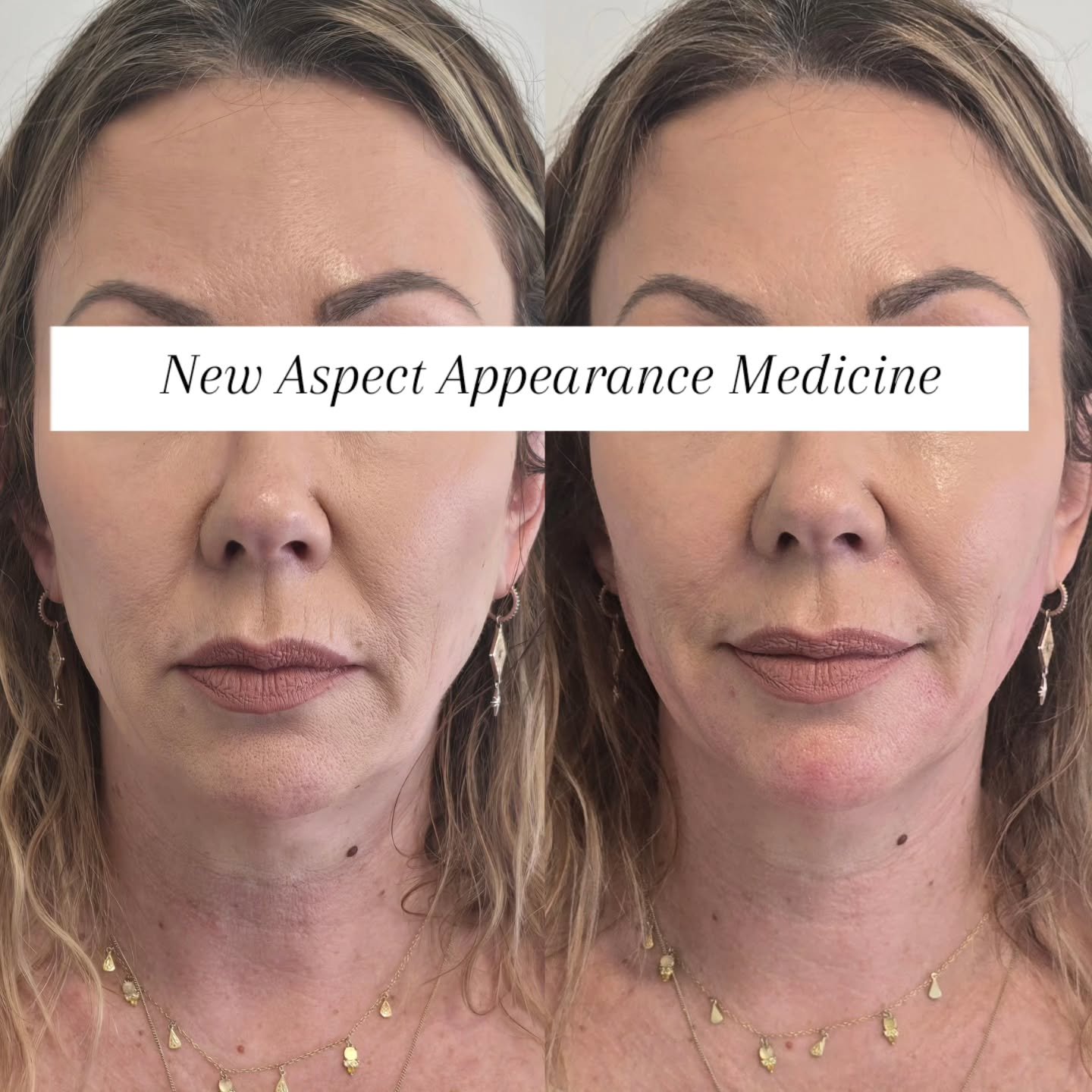 When we talk about lower-face rejuvenation, it&rsquo;s never just about filling lines it&rsquo;s about restoring support, improving balance, and fine tuning to improve shadowing.  Here this beauty was concerned with her lower face and lack of support