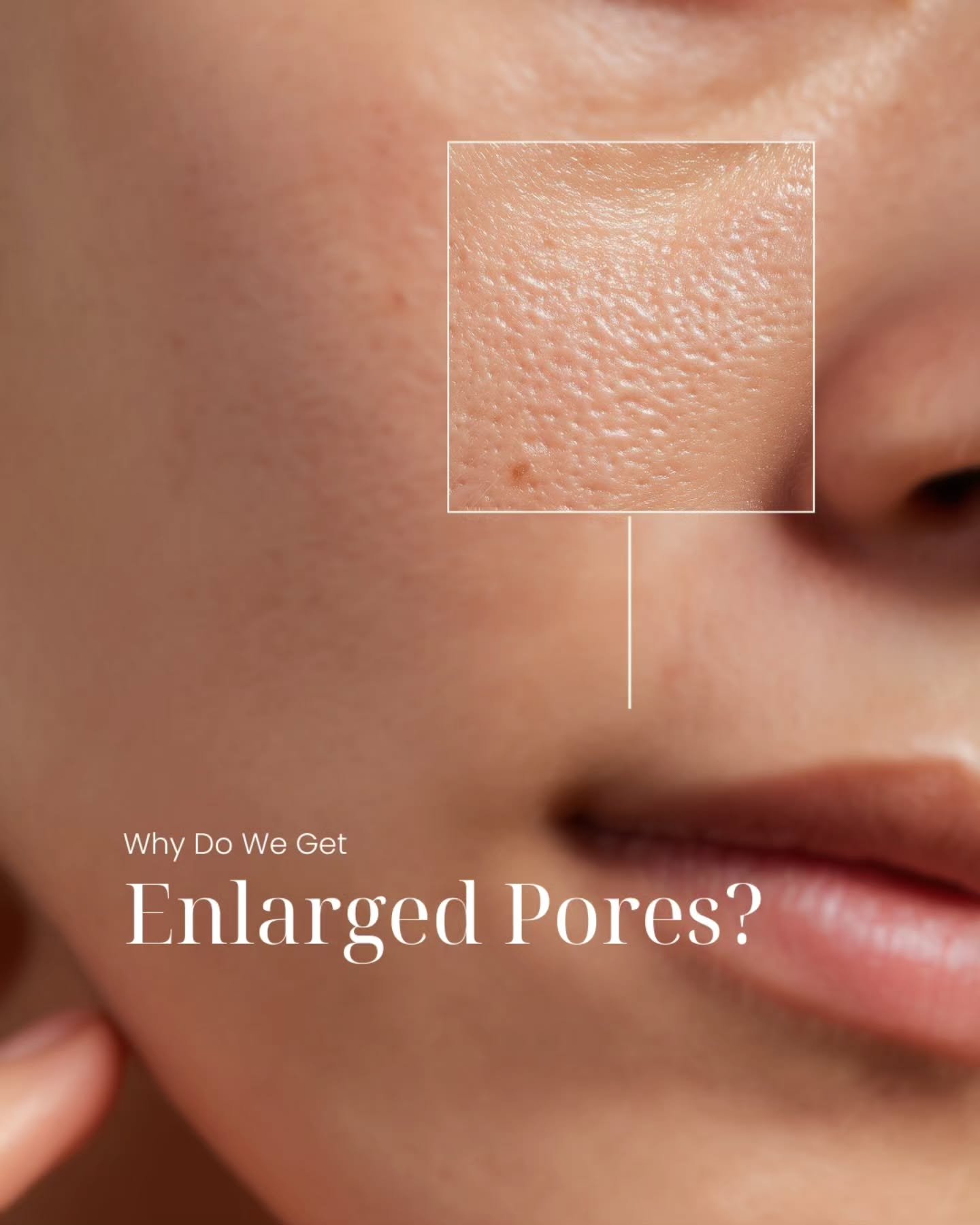 Why pores become enlarged:

1. Oil production
Your pores are actually tiny openings for oil glands. When your skin produces more oil, the pore has to widen so the oil can reach the surface.

2. Genetics
Some people naturally have more visible pores, 