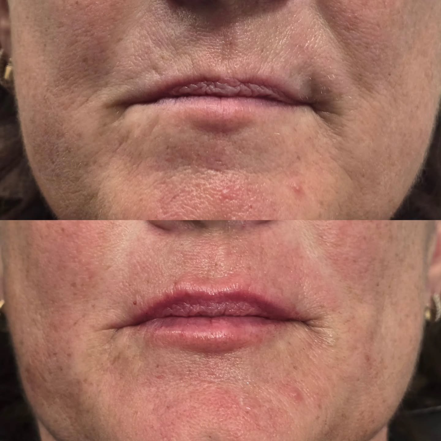 Natural Lip Filler: Subtle, Soft &amp; True to You

Here&rsquo;s what natural actually means in aesthetic terms:

1. We focus on shape
Natural results come from enhancing your existing lip anatomy, defining the vermillion border, restoring the Cupid&