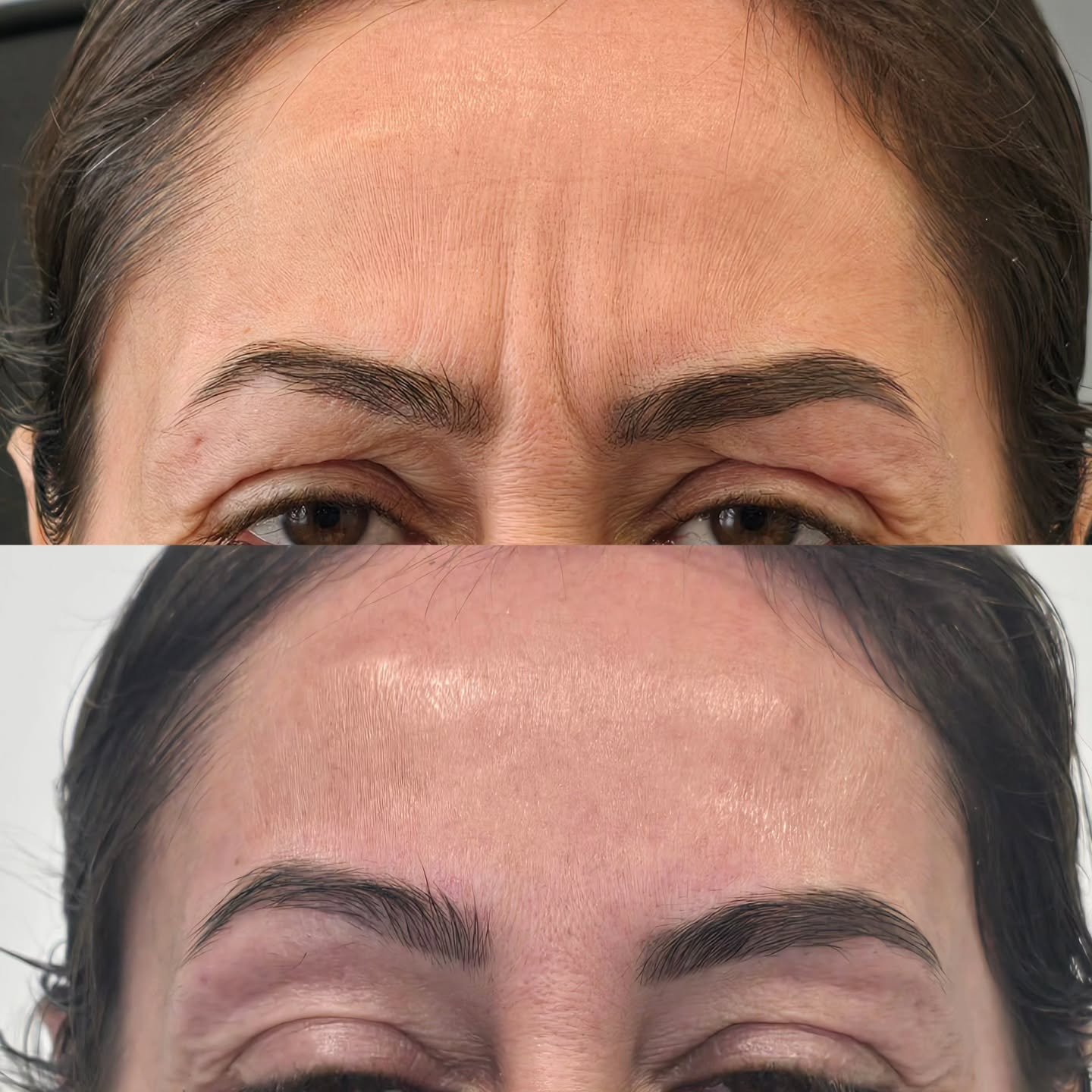 Why treating frown, forehead &amp; crow&rsquo;s feet together creates lift and harmony

The upper face works as a connected muscle system. When one area is treated in isolation, other muscles often compensate and this is where heaviness, brow drop, o