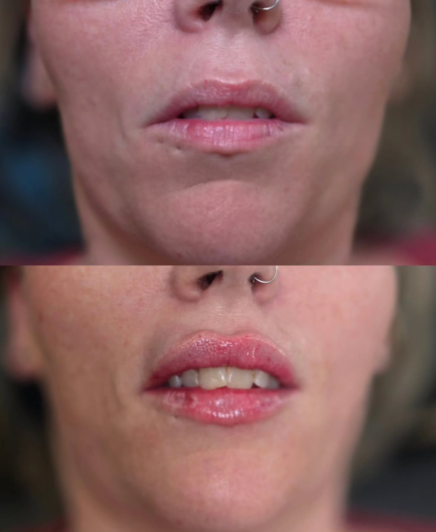 Absolutely obsessed with these lips! 

Beautiful shape to begin with but this beauty wanted a bit more volume and definition and that's exactly what she got! 

As you can see she has a wee hematoma above her lip. On the very last injection I hit a bl