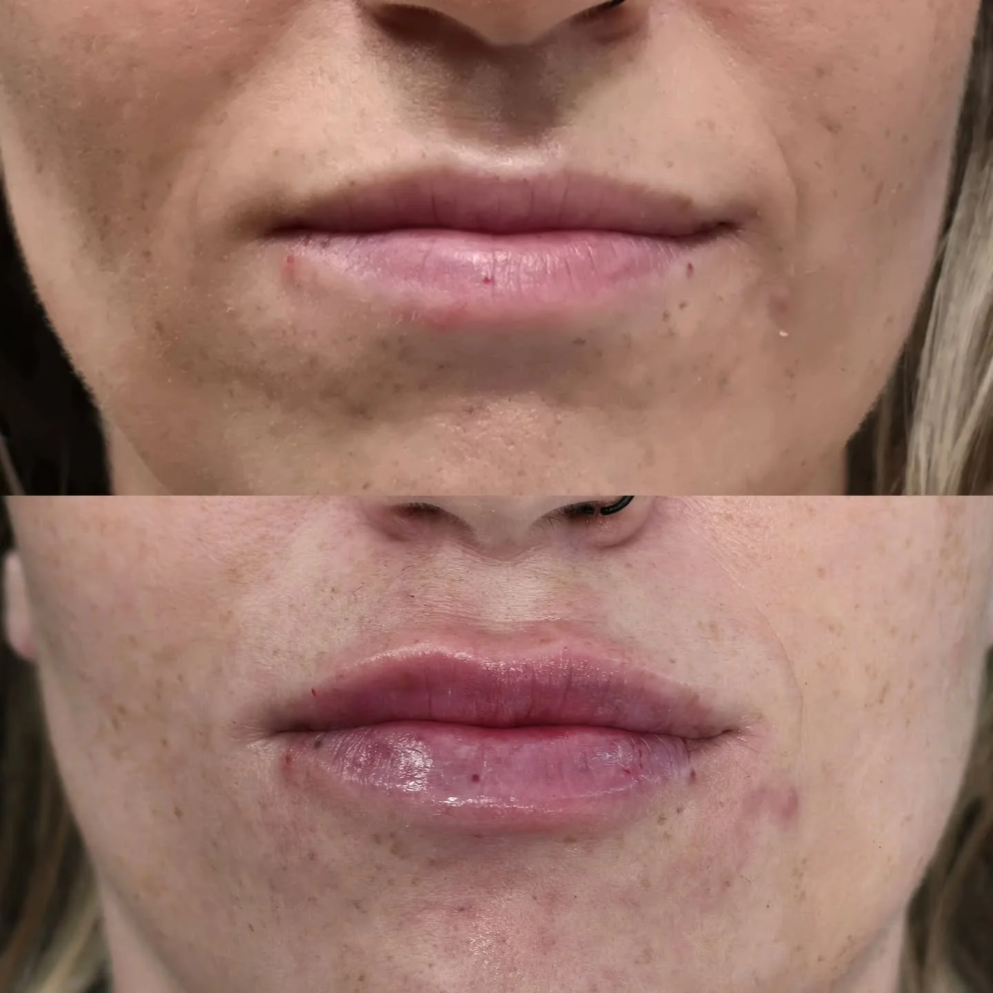 ✨️Beautiful, natural lip enhancement for my beauty ✨
Soft structure, improved hydration, and subtle definition, respecting my client&rsquo;s natural lip shape. The goal is balance, not overfilling.
Lips should look like yours, just refreshed.