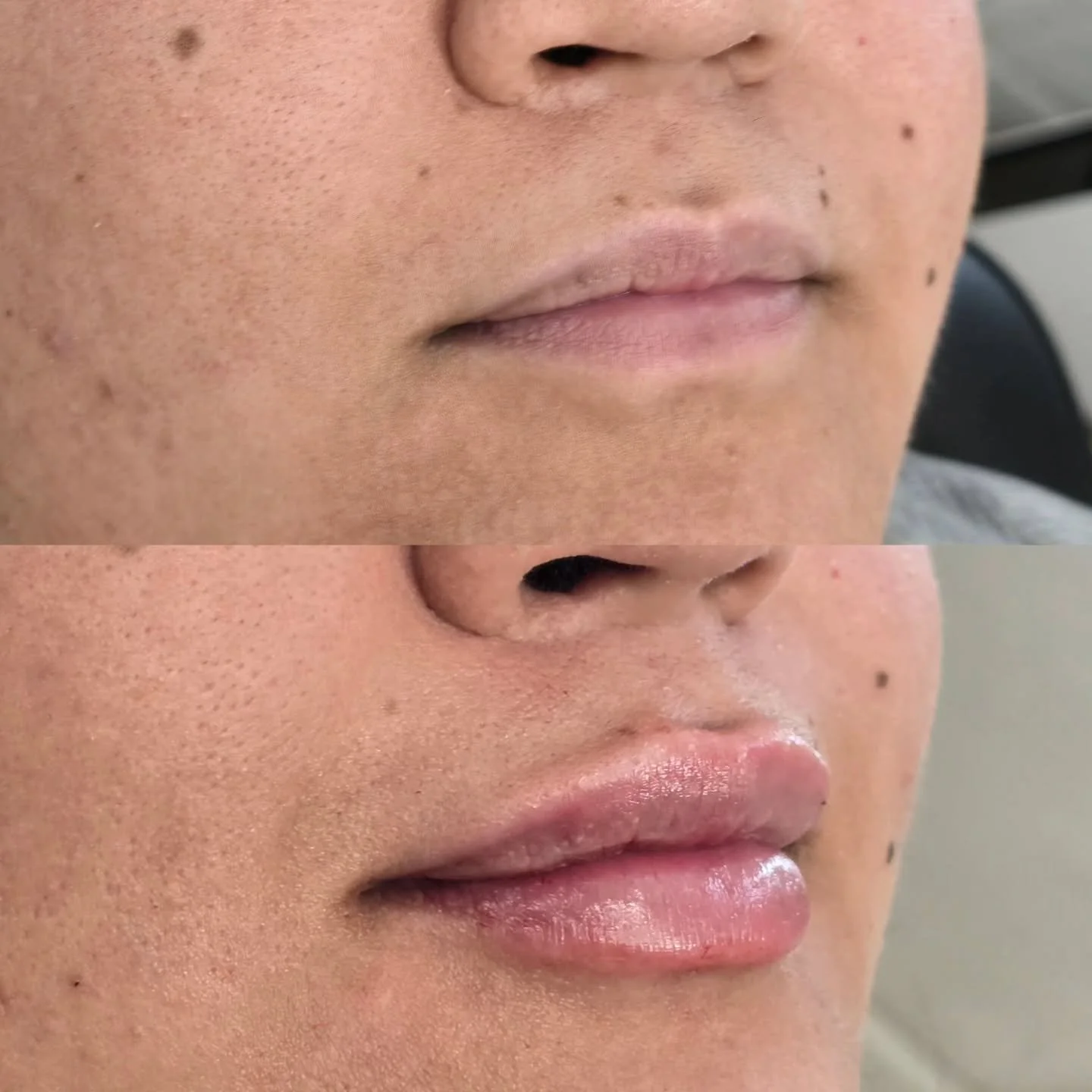 Why lips often need more than 1ml 💋

This surprises a lot of people.

1ml of dermal filler sounds like a lot&hellip; but in reality, it&rsquo;s very small when spread across:
&bull; the vermillion body
&bull; structural support
&bull; asymmetry corr