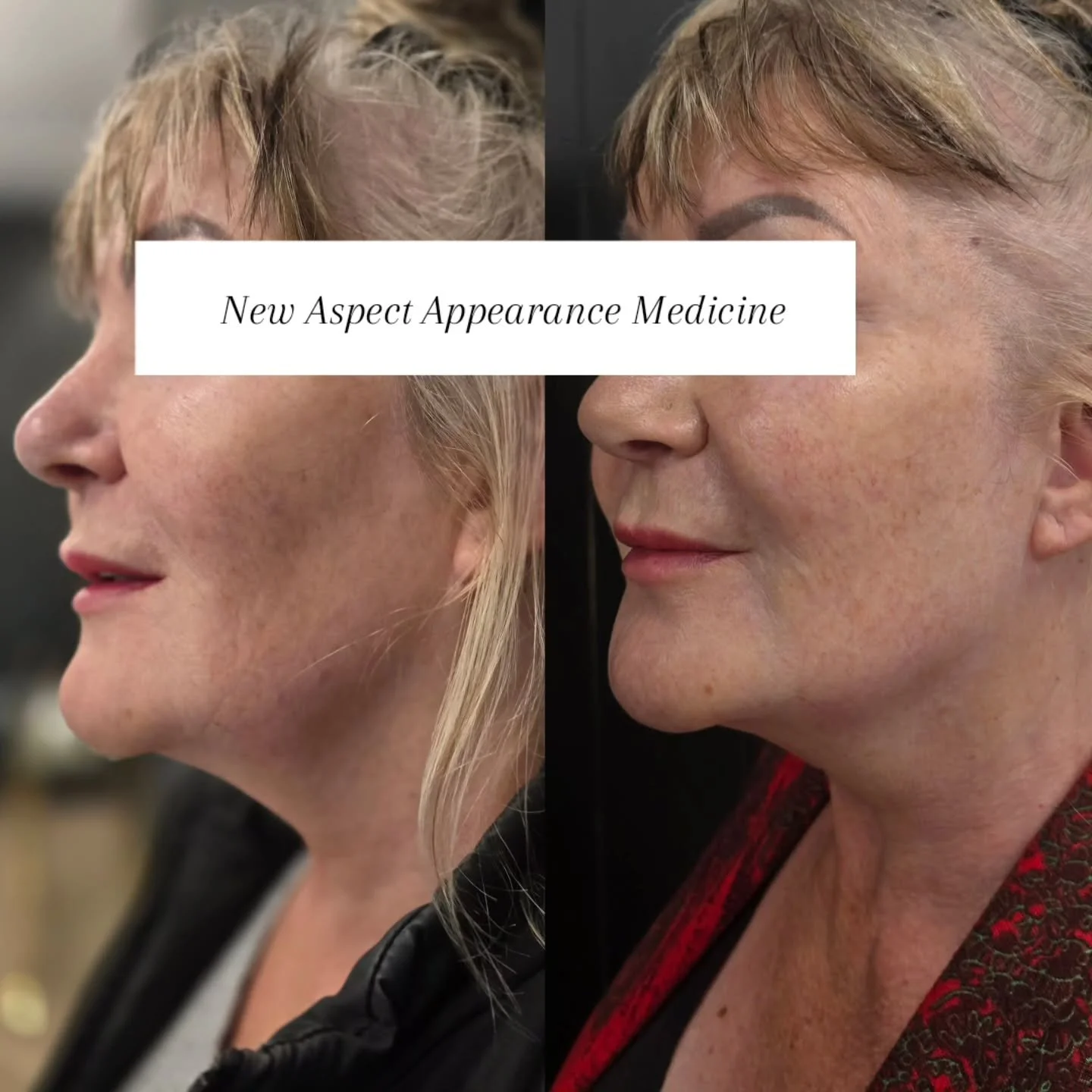 Chin Sculpt HIFU

This gorgeous client came in concerned about heaviness under the chin and jawline. The goal was a slimmer more defined lower face.

By treating multiple depths (including the deeper fat layer and the skin-tightening layers), we were