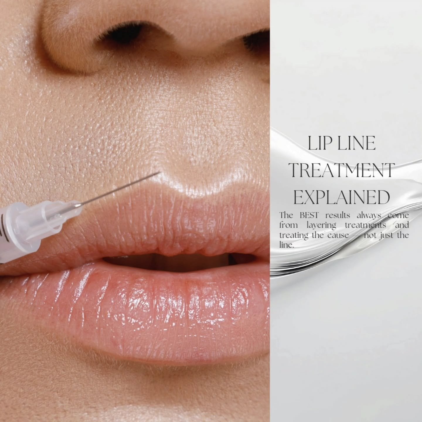 Lip lines are one of the most common concerns I treat&hellip; and also one of the most misunderstood.

There is no single magic treatment that fixes them completely. Lip lines form due to a combination of:

&bull; Loss of collagen and elastin
&bull; 