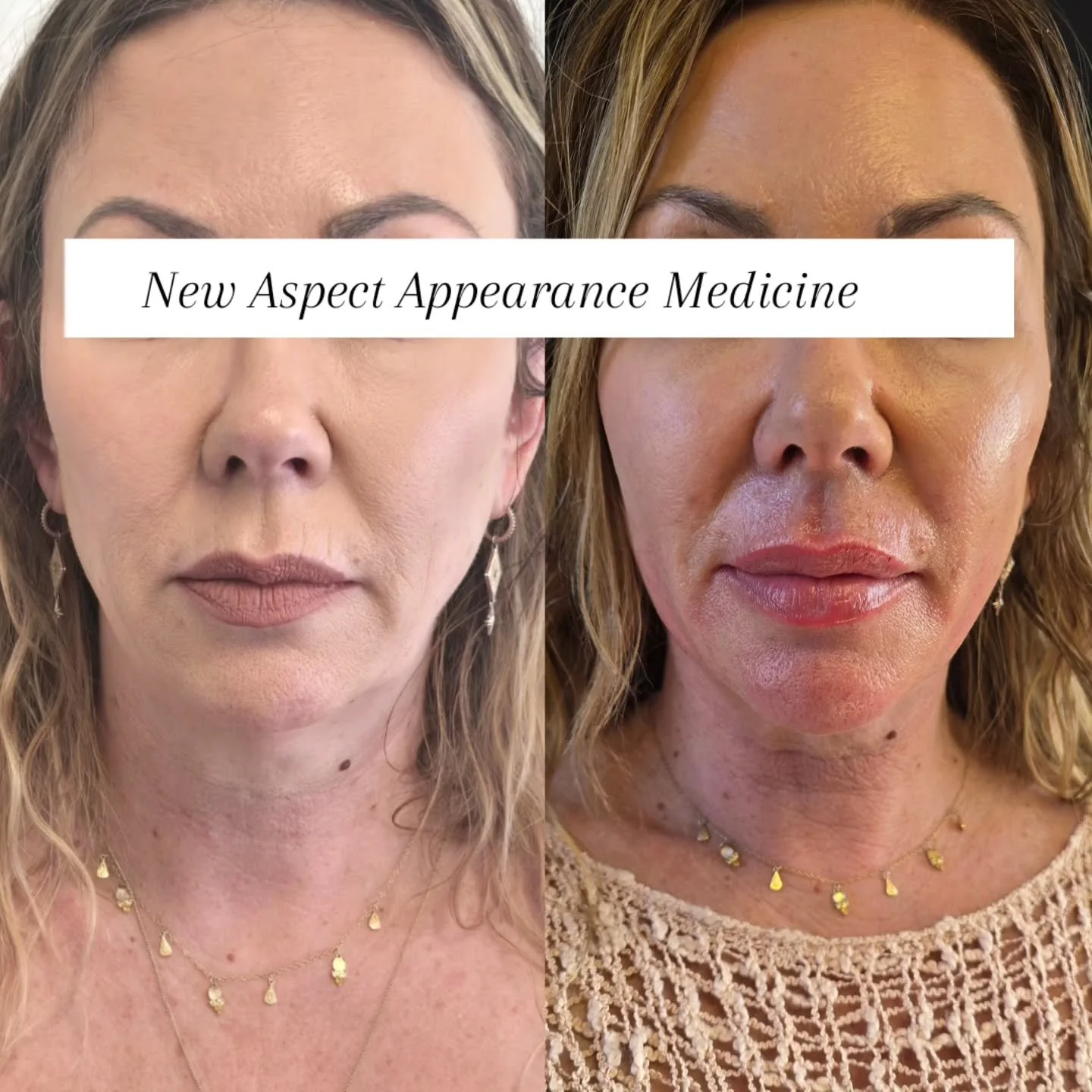 This beautiful client was treated with neuromodulator including the lower face (several days prior to the after photos). By softening the downward pull, we can create a subtle lift through the cheek area&hellip; sometimes it can even look like cheek 