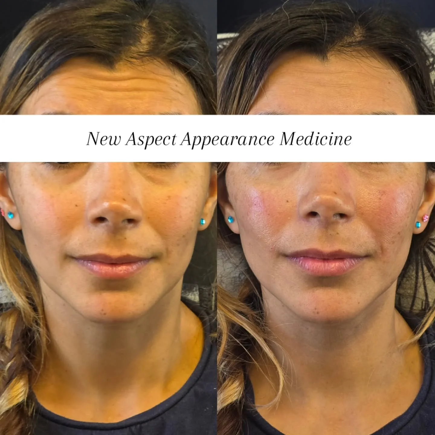 Here we added some cheek support to this absolute stunner aswell as strategically placed anti-wrinkle to help lift the brow and jawline (this will take 2 weeks to take full effect).

✨ Cheek support can completely change the way the midface and under