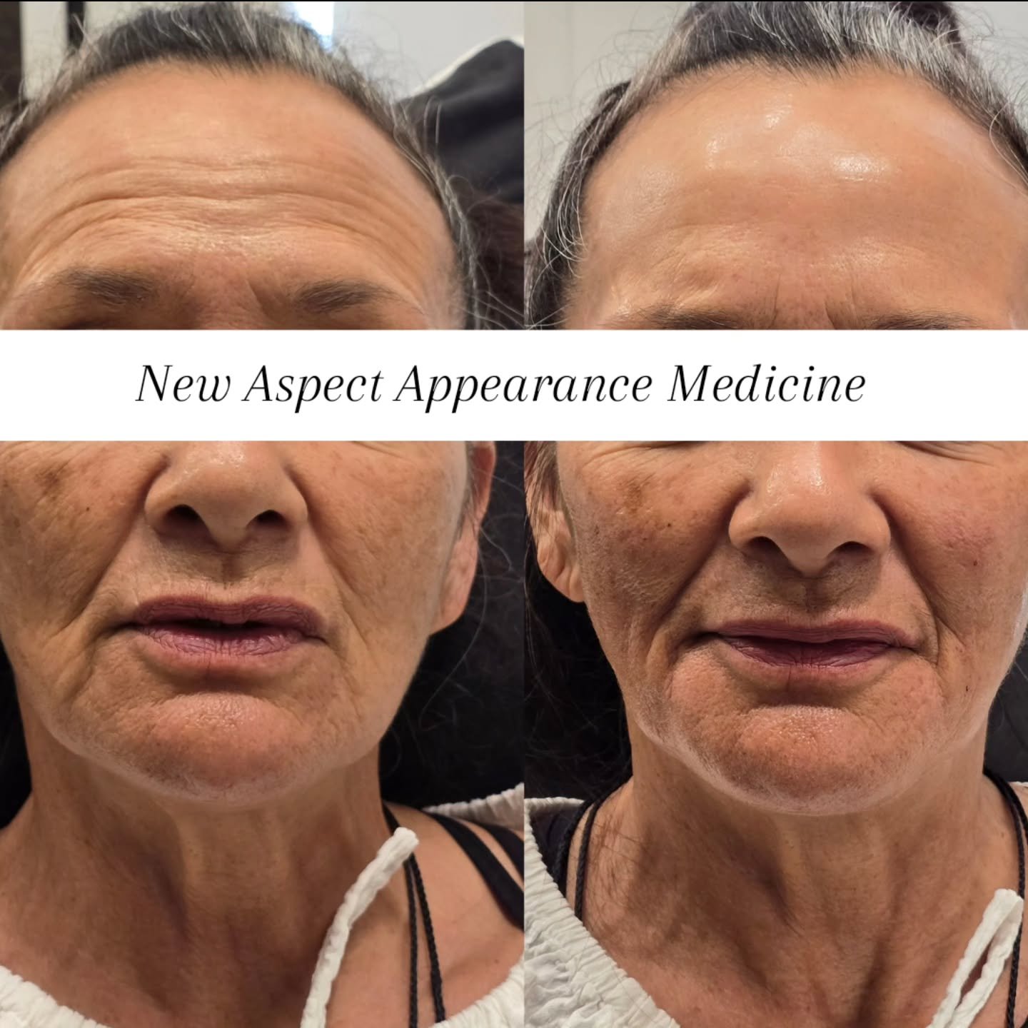 Facial rejuvenation isn&rsquo;t about changing a face.
It&rsquo;s about restoring what time has gently taken away.

As we age we lose bone support, fat pads shift ans decend, collagen declines and skin quality changes. When structure goes, shadows an