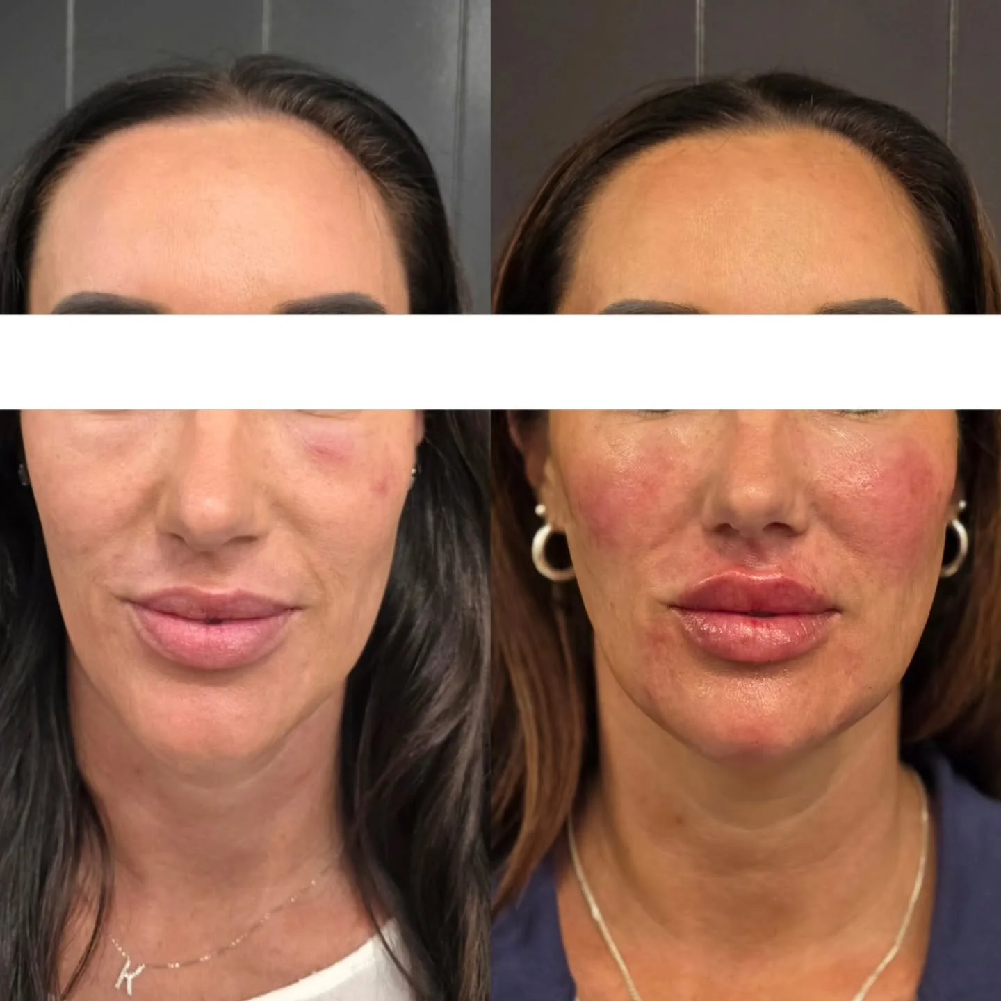 Maintenance makeover*

Yesterday my out-of-town client visited for a refresh/maintenance appointment.

We placed&nbsp;2.5ml&nbsp;in total, carefully layered in small amounts through the:
&bull; temples
&bull; midface
&bull; nasojugal area
&bull; chin