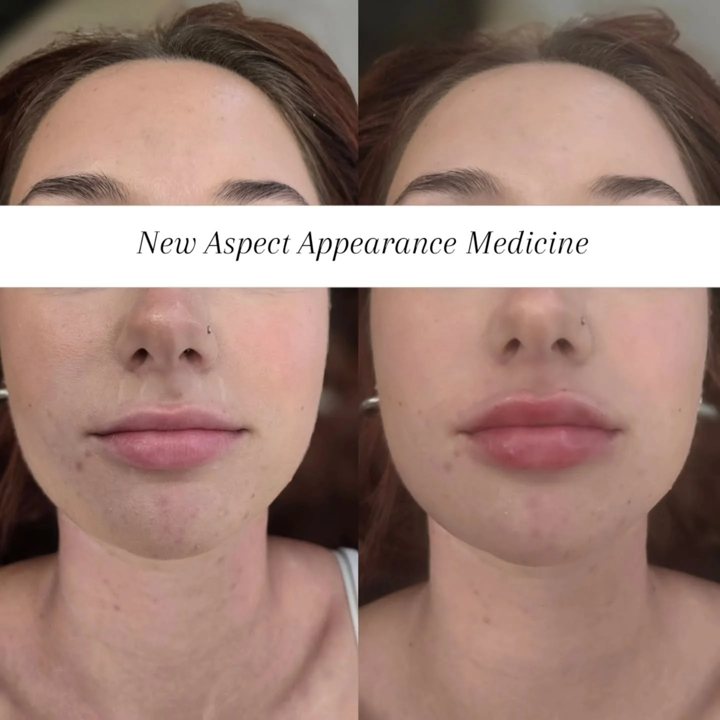 Another beautiful out of town client here for lip augmentation 😍

In this treatment the brief was simple:
* enhance the top lip so it better matches the volume of the bottom
* keep things soft &amp; natural 
* respect her natural shape

The lower li