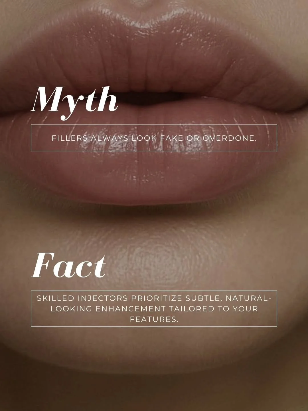 *Let&rsquo;s Talk About Filler Fear*

There&rsquo;s a persistent myth that dermal filler automatically makes people look fake, puffy, or &ldquo;overdone.&rdquo; It&rsquo;s time to clear that up.

Myth: &ldquo;All filler looks fake or overdone.&rdquo;