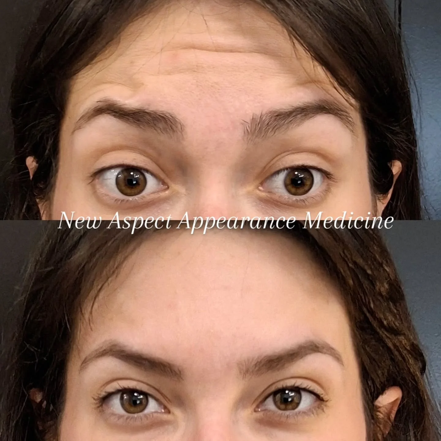 FROWN + FOREHEAD TOGETHER = BETTER RESULTS 

Your frown muscles (glabella) and your forehead muscle (frontalis) work against each other. They are functional opposites.

* The frown muscles pull DOWN and IN
* The forehead muscles lift UP

If we treat 