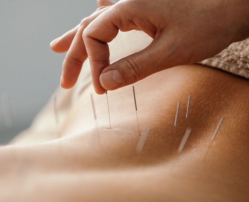 Back Pain Relief with Acupuncture: A Natural Solution That Works