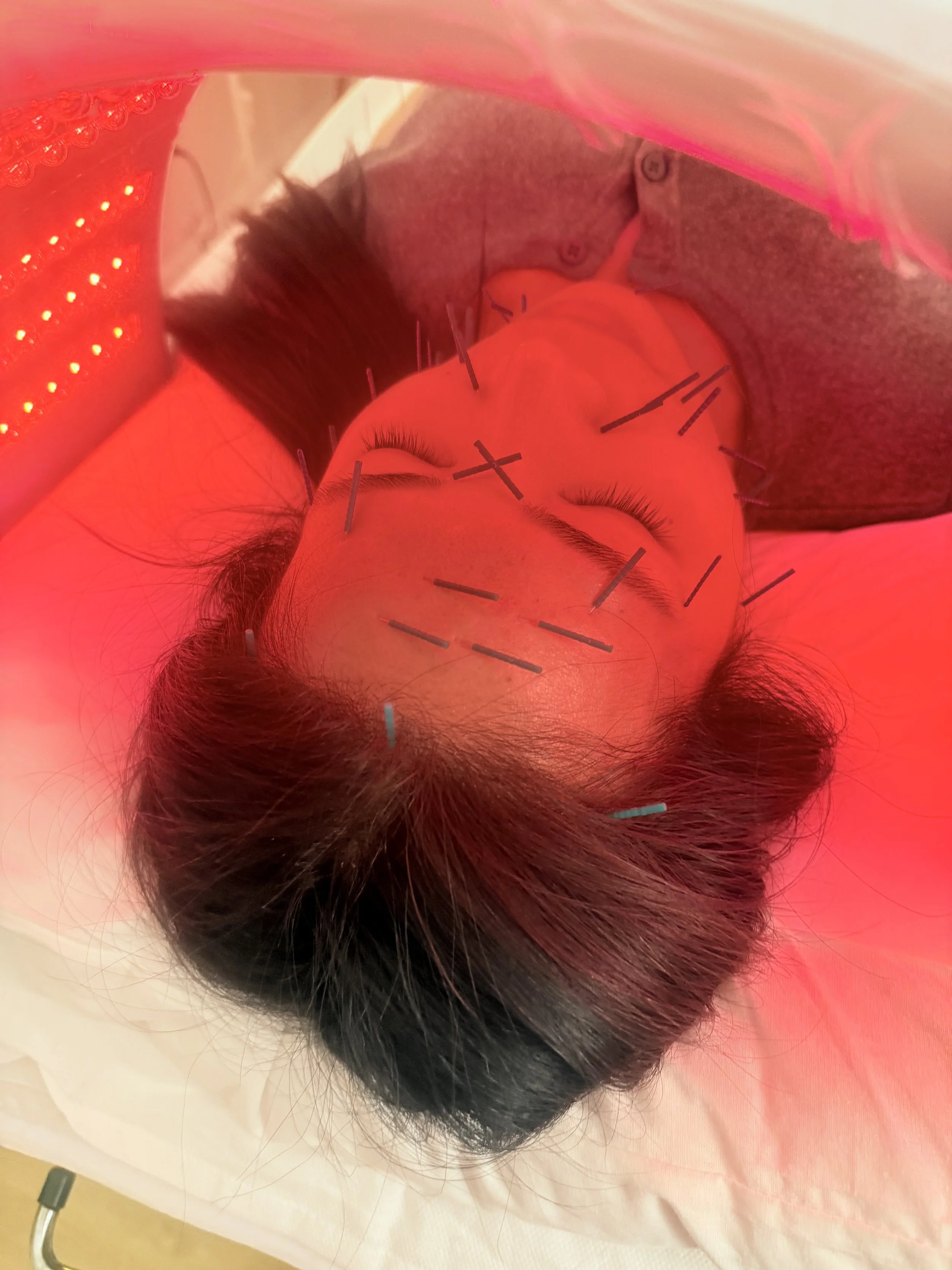 Person receiving facial acupuncture treatment with multiple needles in their face, lying down with eyes closed, wrapped in a towel.
