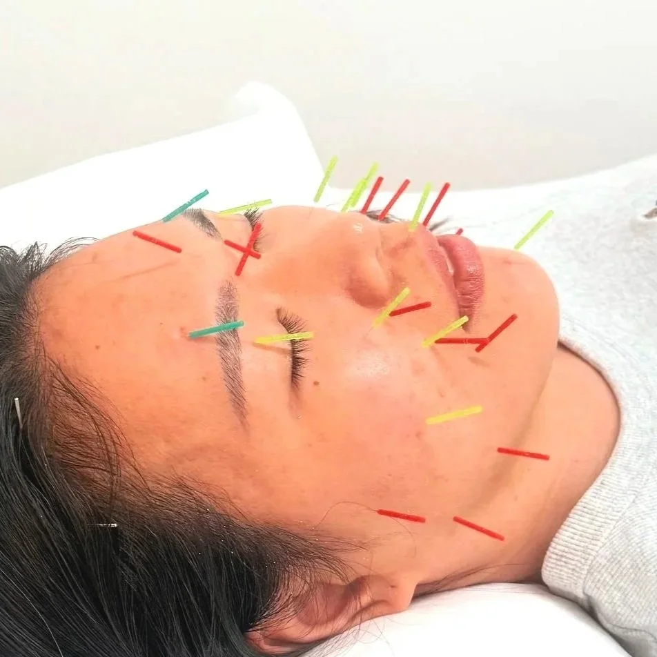 Close-up of a person performing acupuncture, inserting thin needles into a patient's skin.