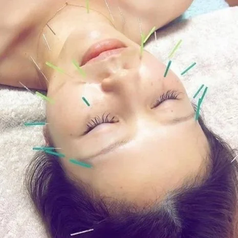 Person receiving facial acupuncture treatment with multiple needles in their face, lying down with eyes closed, wrapped in a towel.