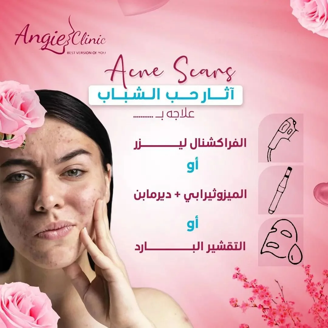 لو عندك آثار حب الشباب أو ندبات وعايز تحسن مظهر بشرتك،  في Angie Clinic 
هيتم  تحديد التشخيص الدقيق علي أيدي افضل  استشاريين التجميل في الاسكندريه وتحديد المناسب لكل حاله سواء الفراكشنال ليزر او الميزوثيرابي والديرمابن أو التقشير البارد وهتحصلي علي ا