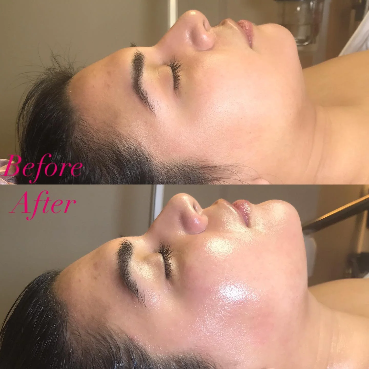 The Goddess Stem Facial utilizes the powerful AnteAGE serum, which is formulated with a blend of stem cell growth factors and cytokines. These ingredients work synergistically to stimulate collagen production, repair skin damage, and promote cell reg