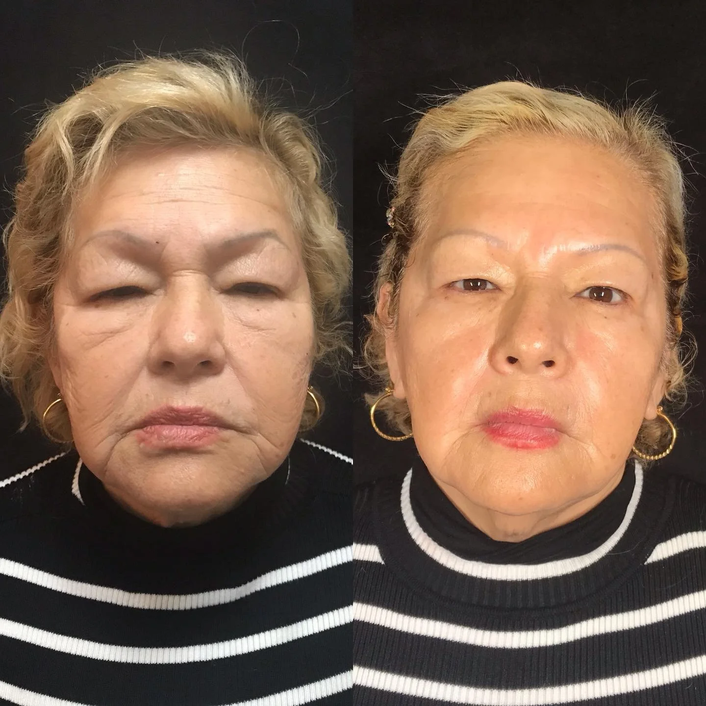 What combination treatment can do…a little bit of biostimulators #prx #radiess #facials #NAD infusion
