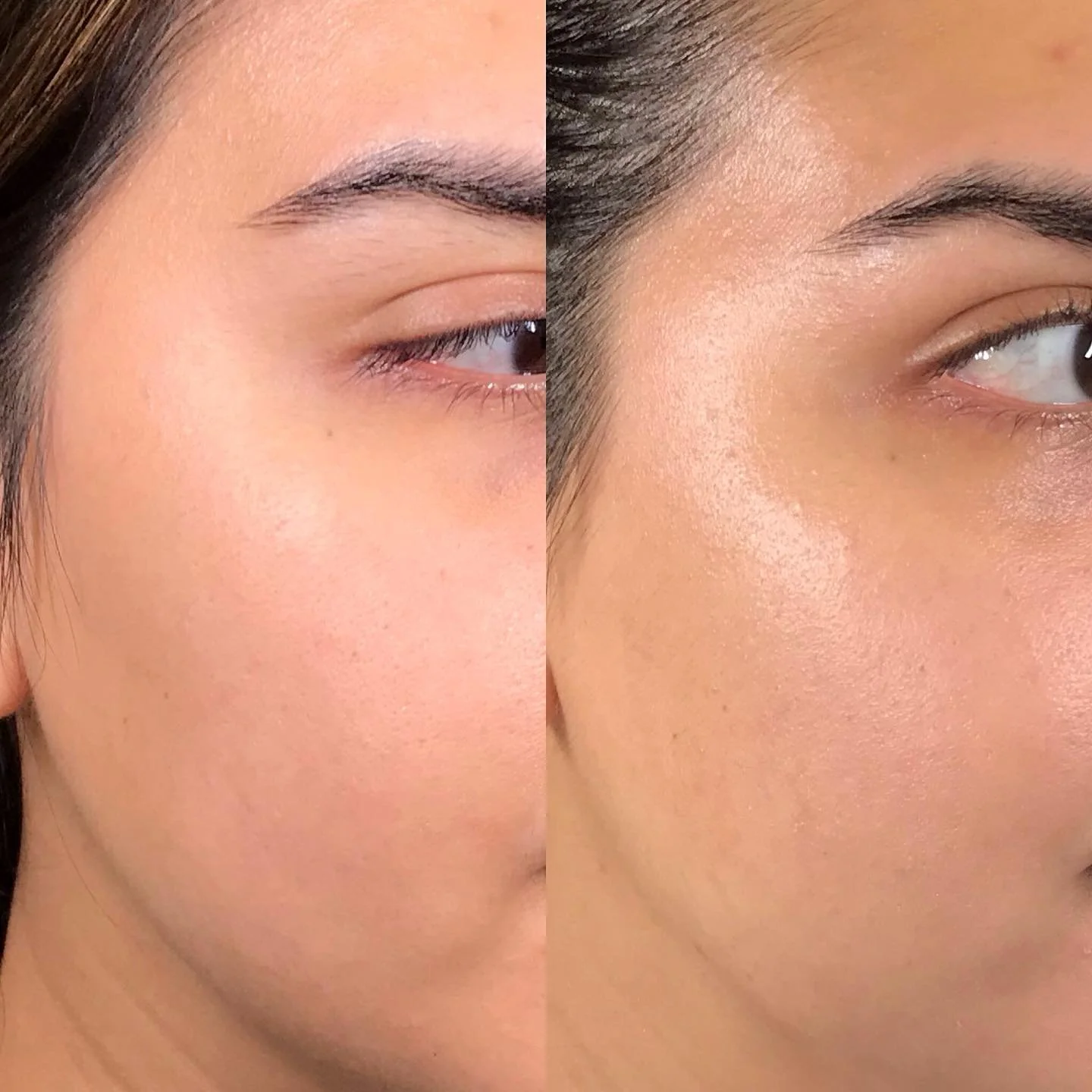 I’m thrilled to share the incredible results I achieved with AquaGold on my client! This cutting-edge treatment delivers powerful benefits through a unique microchanneling system that infuses customized serums directly into the skin.
π§ Benefi