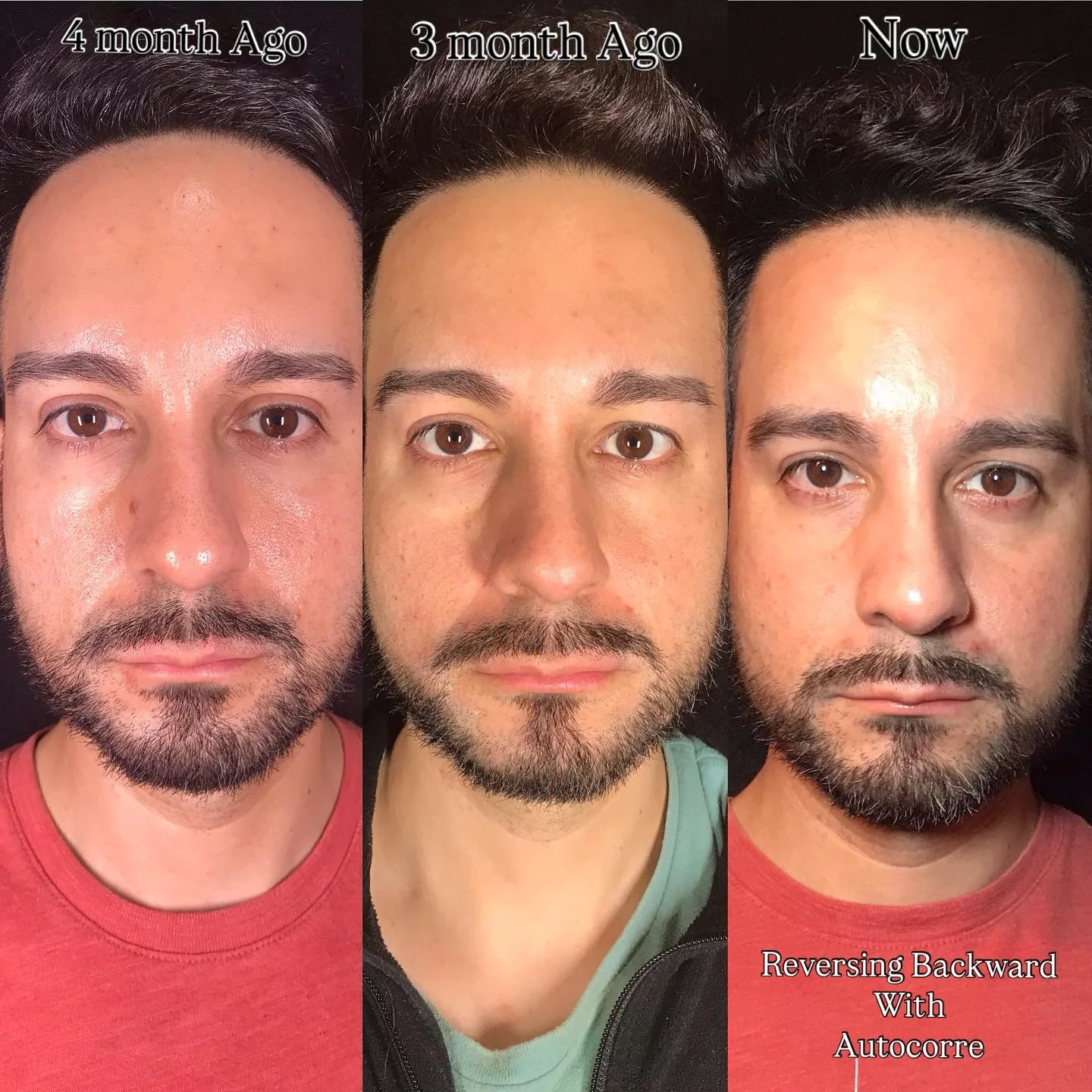 At Caleyo Wellness, we don’t just offer regenerative treatments—we experience them ourselves! After just 3 AutoCorre sessions, the results speak for themselves: smoother, firmer, and more youthful skin.
Why AutoCorre?
β
 Stimulates collag