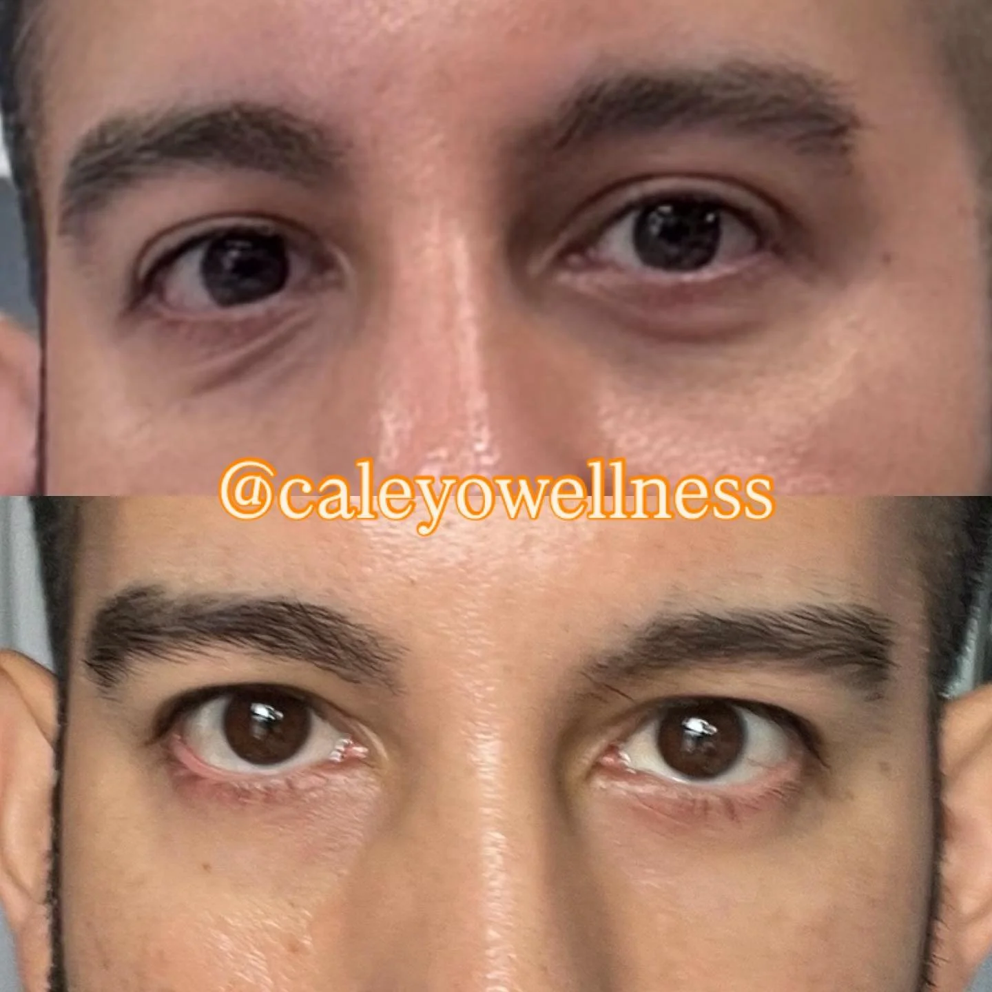 PRP Eye Restoration: Before & After 
Tired of looking… tired?
PRP (aka liquid gold) uses your body’s own healing power to brighten dark circles, smooth fine lines, and restore volume under the eyes — naturally.
No fillers. Just