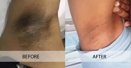 biorepeel-before-after-3.jpg