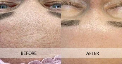 biorepeel-before-after-6.jpg