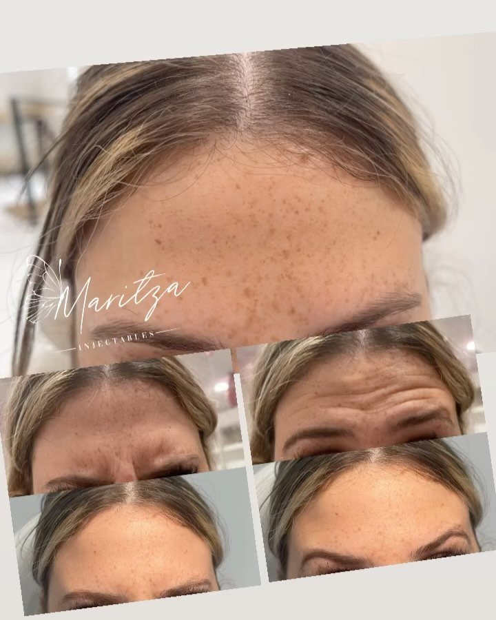 ✨ Before &amp; After: Botox for the forehead ✨

Say goodbye to forehead wrinkles and hello to smoother, more youthful skin! 💉

✨ Check out these incredible results from our Botox treatments. Notice how the lines and creases have been softened, leavi