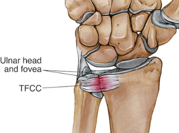 TFCC Tear