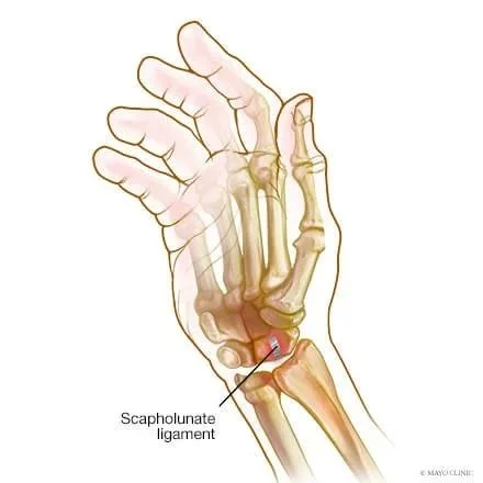 Wrist Sprain