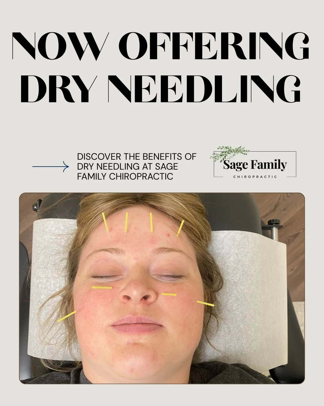 We&rsquo;re excited to introduce Dry Needling&mdash;an effective way to ease muscle tension, reduce pain, and support your healing journey. Another step toward helping you move and feel your best.

What can dry needling help with?
Headaches/Migraines