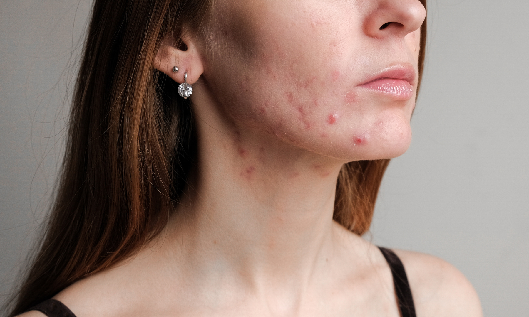 Understanding and Treating Postpartum Acne