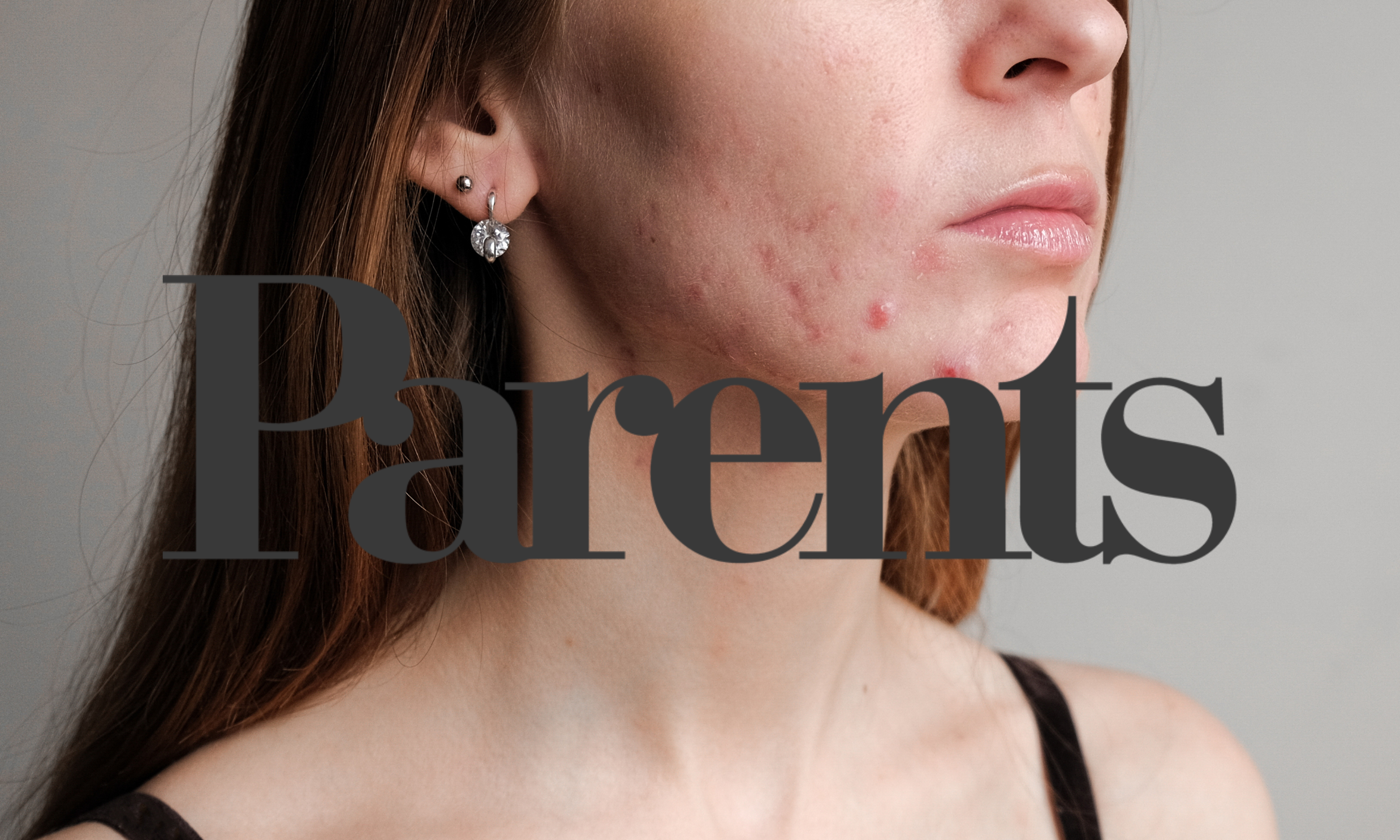 Understanding and Treating Postpartum Acne