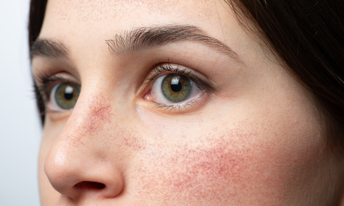 Understanding Rosacea — and the Most Advanced Treatment Options Available Today