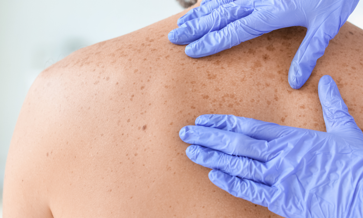 May Is Skin Cancer Awareness Month Prevention, Protection &amp; Early Detection