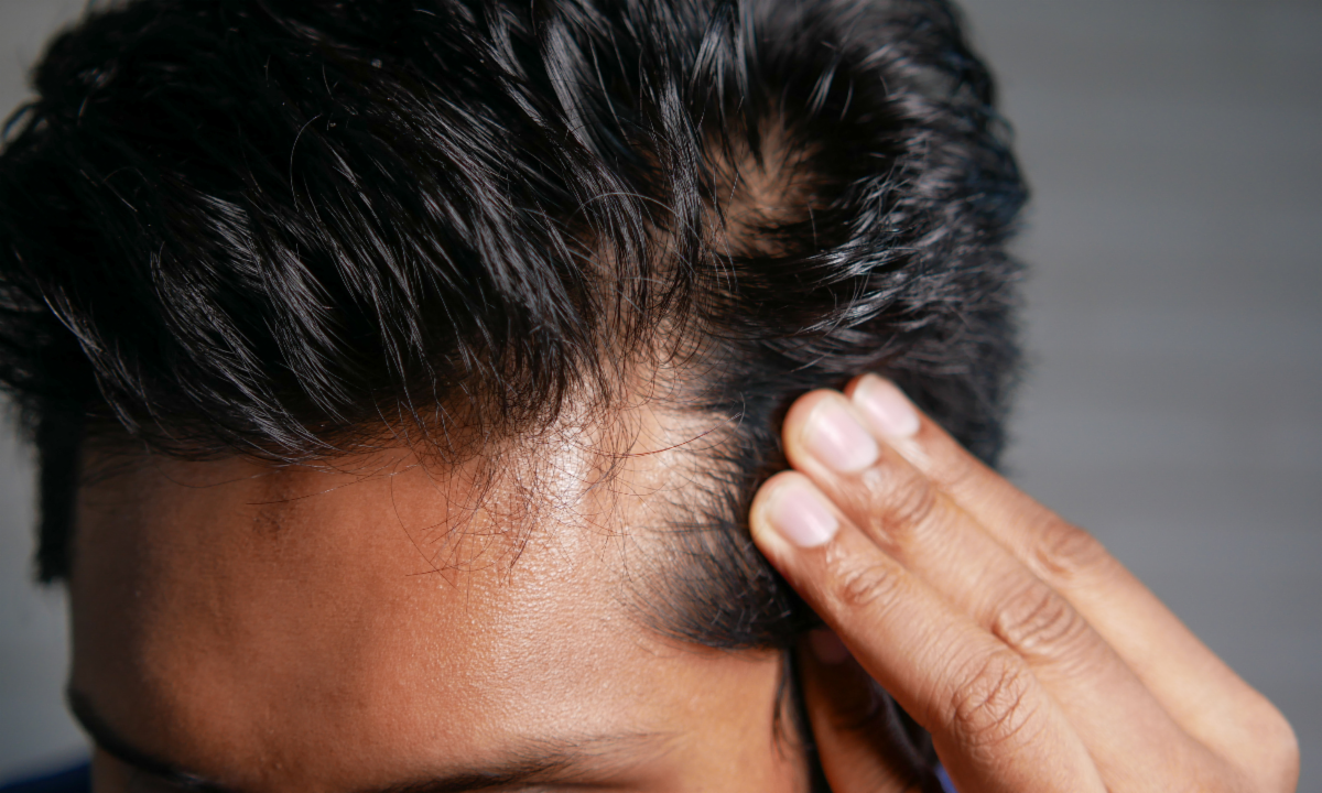 Let's Talk About Hair Loss