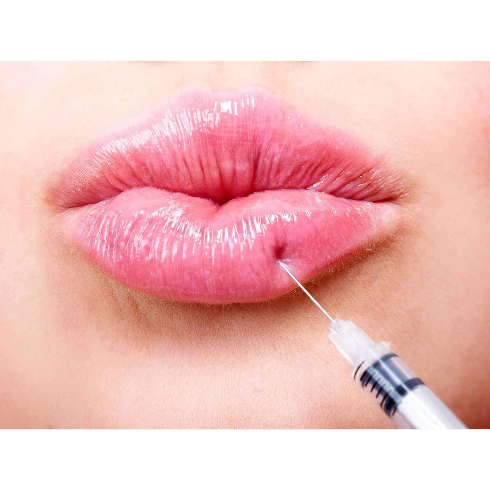 Dermal Filler 7.jpeg