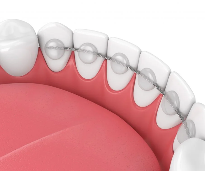 Illustration of lower teeth with a permanent retainer