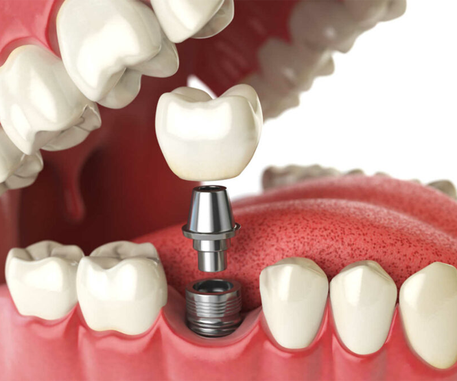 3D illustration of a dental implant procedure showing a tooth crown, abutment, and implant screw in the gums.