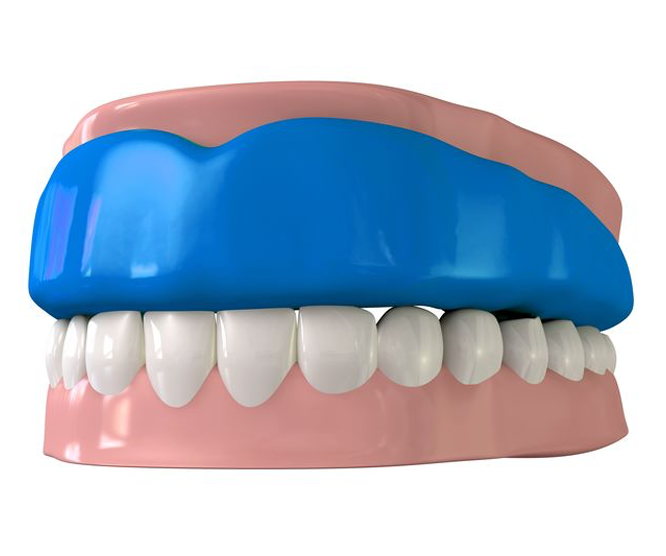 Illustration of a mouth with a blue dental night guard covering the teeth and gums.