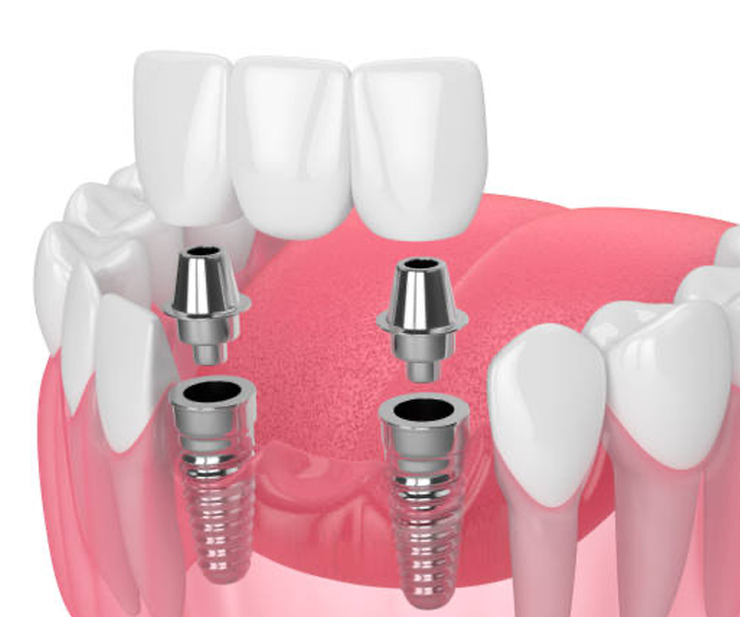 3D illustration of dental implants in gums with dental bridge.
