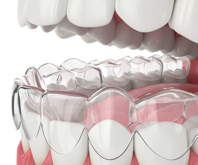 Close-up of a transparent dental aligner on teeth
