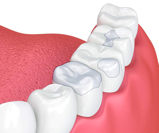 3D illustration of teeth and gums with dental sealants applied to molars, showing a cross-section view inside a mouth.
